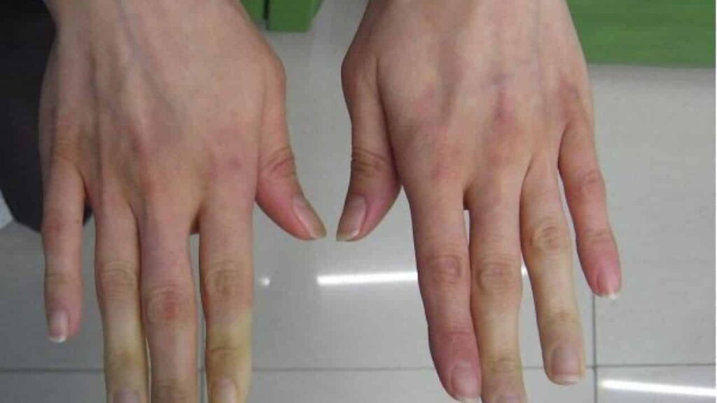 romatizma rüyası | Rüya tabiri ve anlamı